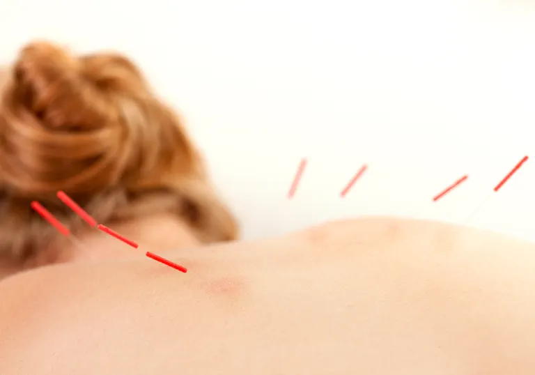 Acupuncture On a patients Back.